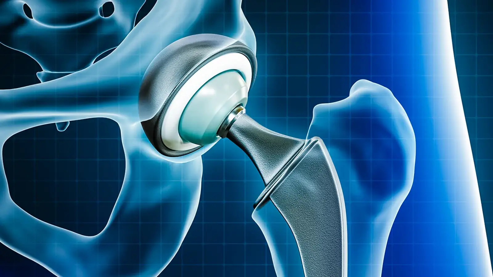 Metal From Joint Implants Found in Human Brains: Risks
