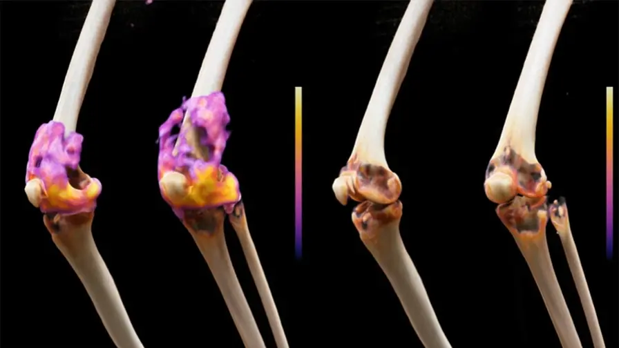 Cancer-style CAR T Cells Reset Rheumatoid Arthritis