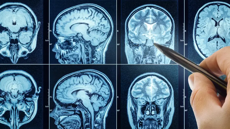 Gut Clues Reveal Decades-Long Warning of Brain Aging