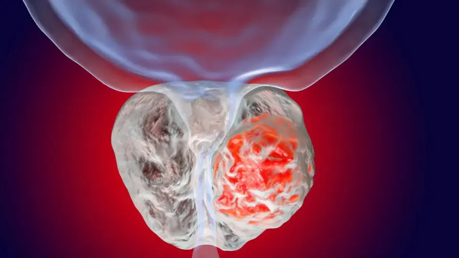 Genetic Footprints Reveal Prostate Cancer’s Hidden Drivers