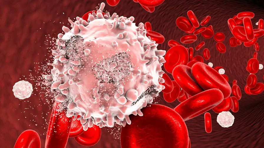 Bones May Predict Survival in Blood Cancer Patients