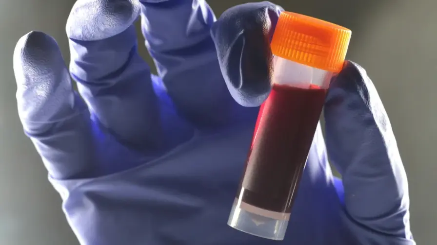 Blood Type B Linked to Modest Rise in Type 2 Diabetes