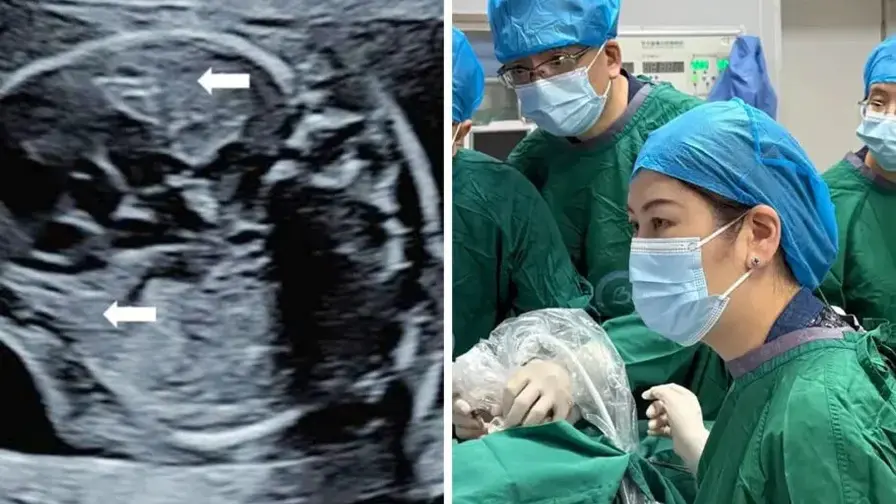 Inside the Womb: Microwave Ablation Saves Fetal Lung Tumor